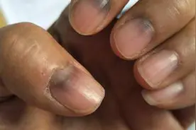 提醒：指甲若长成4种样子，可能是癌或疾病的信号，还请留心观察图片