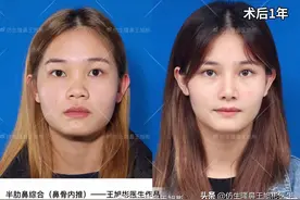 常见鼻整形项目案例合集！看完这篇，你也会“看鼻”了图片