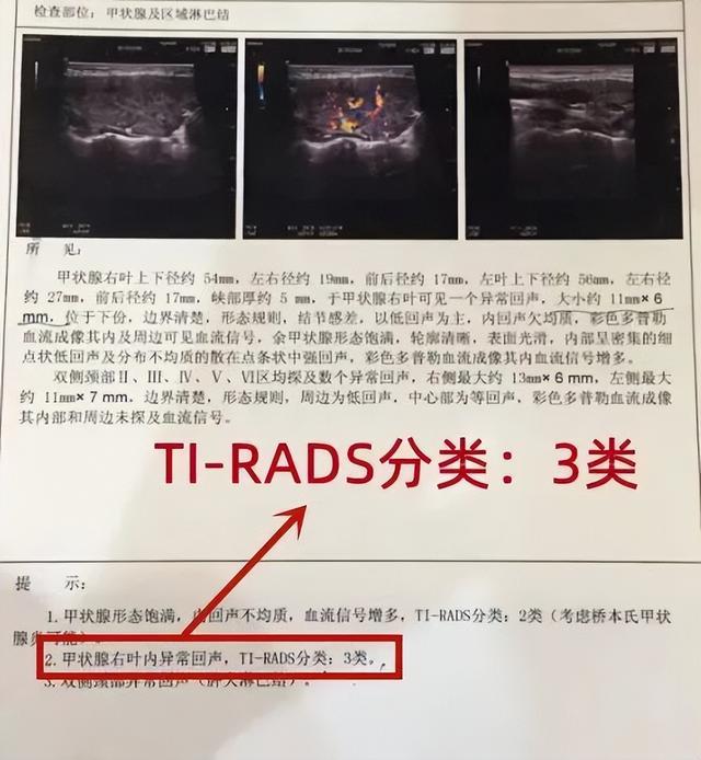 甲状腺肿瘤的超声图像特征（甲状腺超声报告看不懂那是你方法没找对）