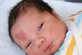 警惕！炎热的夏季对胎记人士有哪些危害？图片