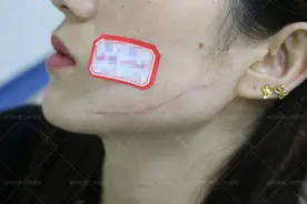 郑州市第二中医院：激光治疗凹陷疤痕怎么样？图片