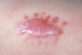 伤口愈合后红色疤痕凸起来了怎么办？红色凸起疤痕怎么治疗？图片