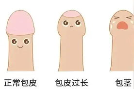 关于包皮不得不说的故事图片