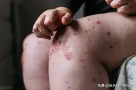 怎么知道自己患有过敏性皮肤病？图片