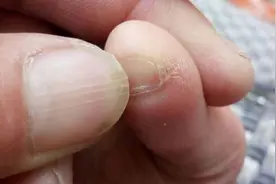 小脚趾甲长成两瓣的人，究竟是什么来头？你知道吗？看完涨知识图片