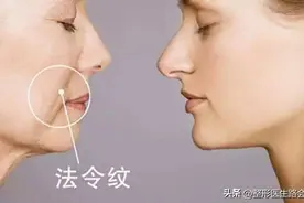 法令纹明显，27岁看着像35+岁！建议做热玛吉？还是填充玻尿酸？图片