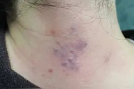 “痧”到底是什么？图片