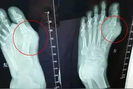 从小爱喝饮料，福建38岁男子被这种病困扰十多年图片