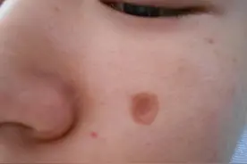 脸上点痣后竟留下“凹坑”的疤痕！这才是正确的处理方式图片