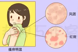 身上突然长大片风团、红斑，是怎么回事儿？图片