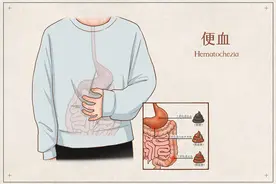 便血只是痔疮的原因吗？还有哪些疾病会造成便血呢？图片