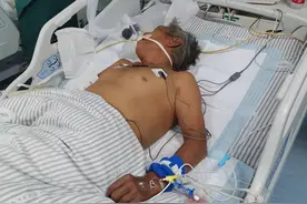 好危险！江西男子被银环蛇咬伤险丧命！有多毒？是眼镜王蛇的10倍图片