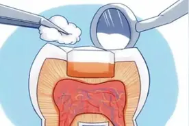 不懂就看过来，补牙材料如何选择？图片