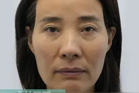 年龄增大，面部呈现“空”“松”“垮”怎么办？医生说出解决真相图片