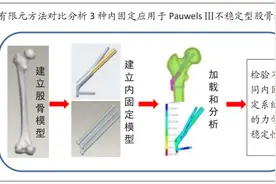 动力交叉螺钉应用于不稳定型股骨颈骨折的生物力学分析图片