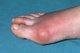 痛风日常生活须知，饮食注意很重要图片