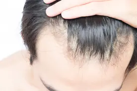 脱发的人性欲好？专业医生辟谣：连雄激素脱发的人都不敢说这话图片