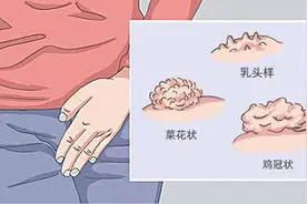 私处长了小疙瘩，警惕HPV感染尖锐湿疣！图片