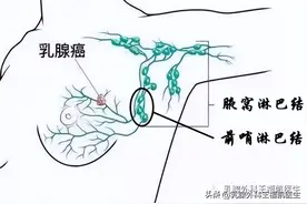 乳腺癌手术（什么是前哨淋巴结，前哨淋巴结活检安全吗？）图片