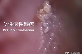 女性外阴旁边长一堆疙瘩是怎么回事图片