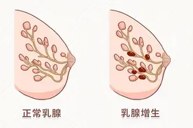 科普中国 医疗健康 | 10个女性8个乳腺增生，查出乳腺增生要不要治疗？图片