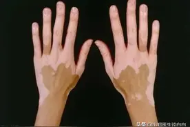 白癜风治疗这两点是禁忌图片