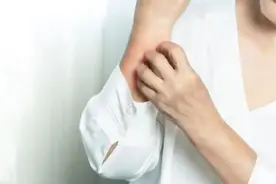 【健康科普】瘙痒难忍的湿疹，你经历过吗？图片