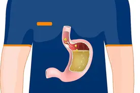 反酸烧心老不好，小心食道裂孔疝图片