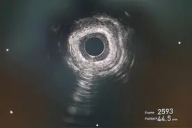 冠脉严重狭窄，还变硬了！怎么办？浙大一院心内科用冲击波球囊精准治疗！图片