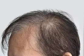 健康早知道：经常洗头更容易脱发吗？图片