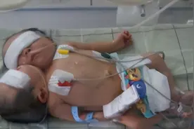 2011年，四川产妇生下国内首例“双头女婴”，随后将医院告上法庭图片