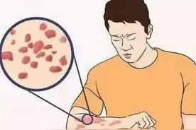 身上起了一片一片红色的很痒图片