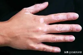 20年白癜风多年未扩散还能复色吗图片