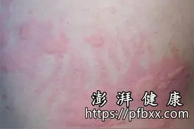 身上无缘无故起包很痒像蚊子咬的是什么原因图片