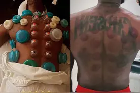 詹姆斯去拔罐，来自神秘的东方力量！老詹这一幕，我们也等了2年图片