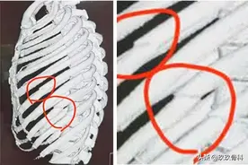 肋骨骨折日常护理—谨记7条更快康复图片