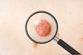 腋窝下为何会长出“小肉粒”？医生：多半与这些因素有关，需重视图片