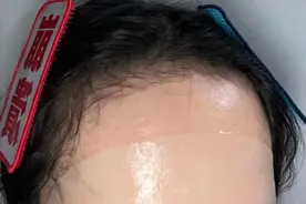 天生发际线高使用米诺地尔有用吗？真实使用记录分享给你们图片