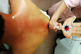 51岁冠心病，刮痧之后心脏舒服了，是真是假？现代医学力证图片