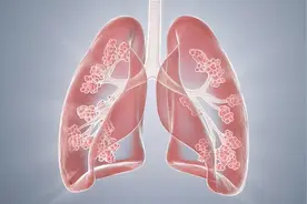 做CT检查发现双肺纹理增多，是怎么回事儿？什么意思？一次说清图片