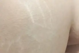 生长纹消失术！好好跟生长纹道个别图片