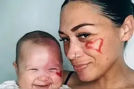 澳洲妈妈激光祛除孩子脸上胎记，却被网友群嘲是怪物妈妈？图片