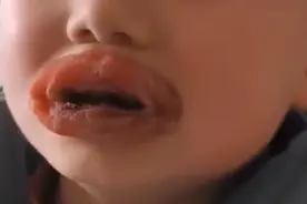 湖北一儿子吃辣条太多嘴巴变香肠嘴，儿子欲哭无泪，爸爸哭笑不得图片