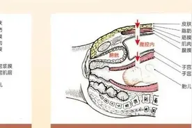 长治医学院附属和济医院丨腹膜外剖宫产助力三胎孕妈圆“好”梦图片