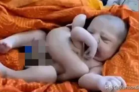 一名印度孕妇诞下4手4脚婴儿，在肚皮上长出手脚民众视为神明化身图片