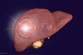 肝癌患者坚持调理了5年，保持得不错，12年后又来找我图片