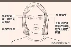 50岁才会眼皮松弛？34岁的她三角眼很显老！提眉手术助她年轻10岁图片