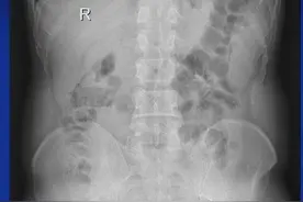 高中生连吃3年烧烤，因为肚子疼，确诊结肠癌晚期图片