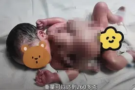 深圳一男婴出生时4手4脚，医生：为全球罕见寄生胎，术后患儿恢复良好图片