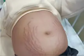 13岁女生肚子爬满“妊娠纹”，隆起似孕八个月，照完CT后妈妈吓懵图片